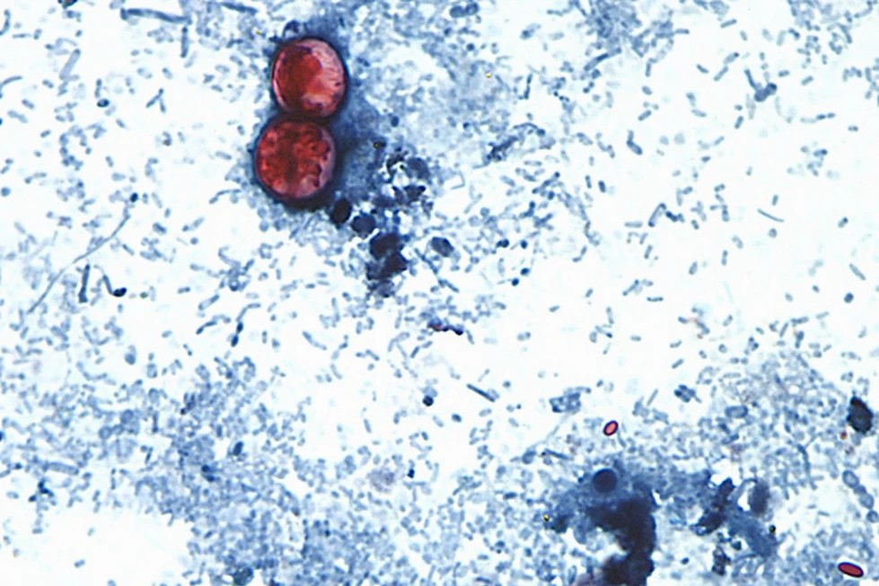 México confirma 33 casos de cyclospora ante brote mortal en EEUU