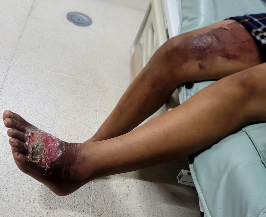 Víctima menor de edad que denunció abuso sexual reiterado por parte del pastor evangélico Emiliano de Jesús Díaz Udiel, en Honduras. La imagen muestra lesiones visibles en sus extremidades. Foto: Itsmania Platero /Los Ángeles Press.